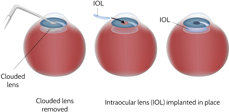 Cataract Surgery